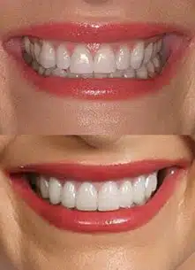 How to Take Care of Dental Veneers