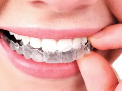 How to Care for Your Teeth with Invisalign