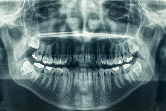 Technology 6 Panoramic dental X-ray showing a full view of upper and lower teeth, jaws, and sinuses, with several fillings visible