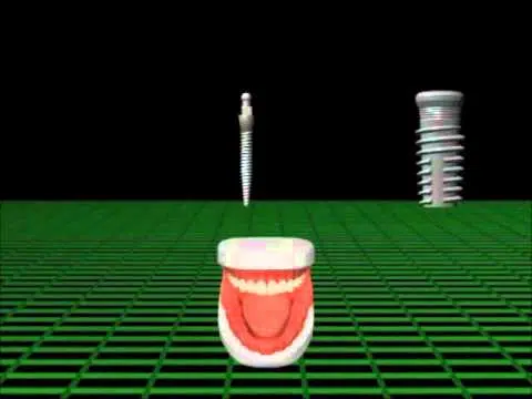 Types of Dental Implants and Procedures