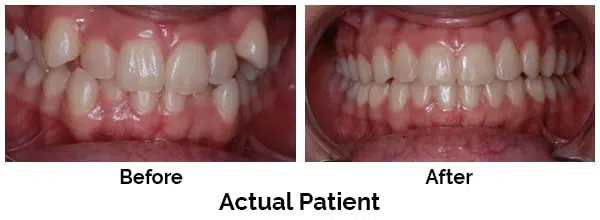 Kirkland Teeth Before and After Invisalign