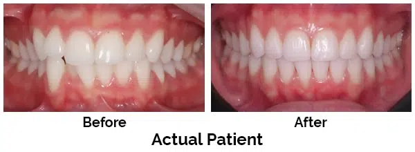 Kirkland Teeth Before and After Invisalign
