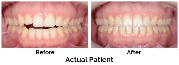 Kirkland Teeth Before and After Invisalign