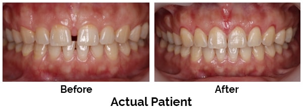 Kirkland Teeth Before and After Invisalign