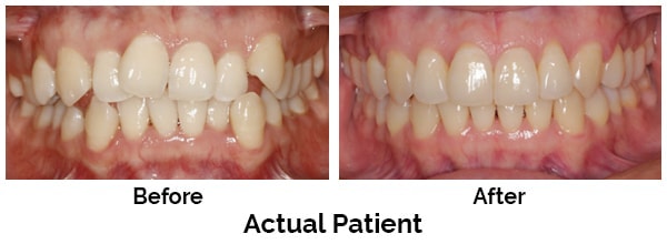 Kirkland Teeth Before and After Invisalign