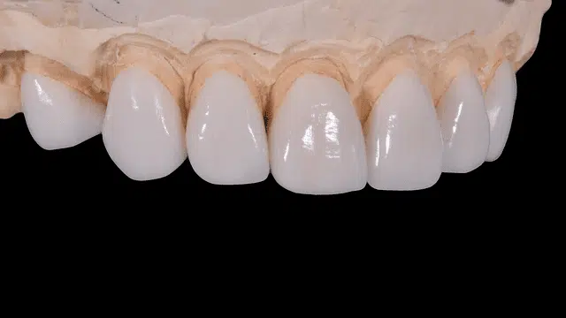 teeth veneers