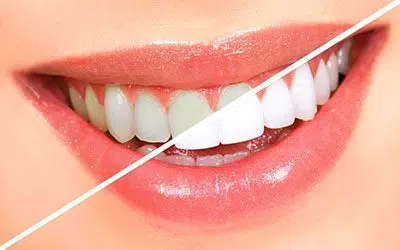 What Type of Teeth Whitening Is Best for Me?